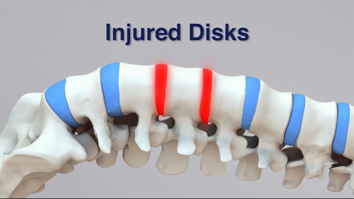 Tenino non-surgical spinal decompression