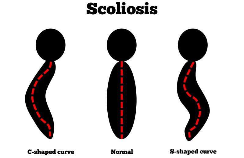 Olympia,  scoliosis treatment